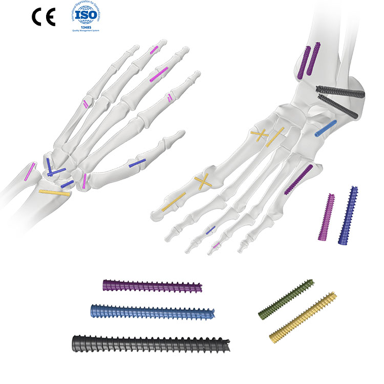Headless Cannulated Compression Screw for Orthopedic Screws – Twily Med