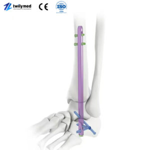 Hindfoot Fusion Ankle Nail