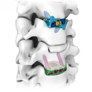 Titanium Zero Profile Cervical Peek Cage